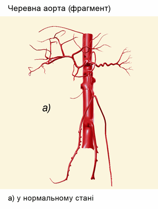 Черевна аорта (фрагмент)