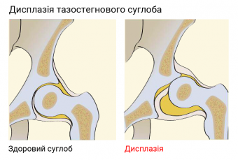 Дисплазія тазостегнового суглоба