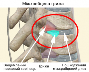Міжхребцева грижа