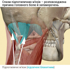 Підпотиличні м'язи