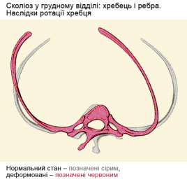 Сколіоз