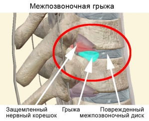 Mezhpozvonochnaja-gryzha_web Mezhpozvonochnaja-gryzha_web