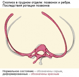 Skolioz_Posledstvija-rotacii_web Skolioz_Posledstvija-rotacii_web